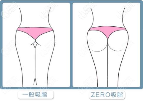 大象腿变细记：我的大腿吸脂经历分享