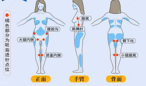 锡林郭勒女性胸部吸脂手术费用大致需要好多