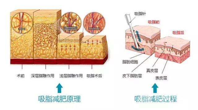 北京阳光整形医院吸脂技术怎么样？瘦身新选择，轻松又无痕