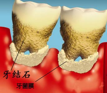 巴中青诚口腔医院价目表，整牙案例图