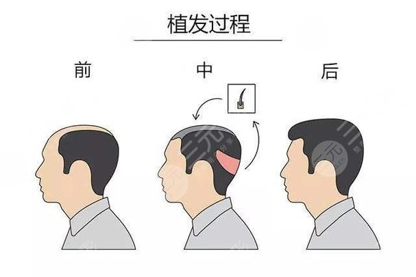 福州格莱美植发医院技术怎么样？资深专家治疗费用解析