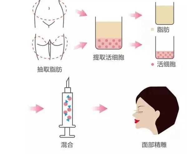 福州自体脂肪面部填充价格费用多少？解析！