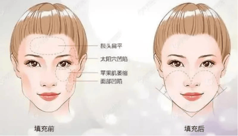 深圳美颜鼻部整形真实案例效果对比图分享，医生解读