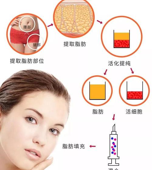 深圳脂肪填充脸部医院排名前三强美丽蜕变，脂肪填充带来的自然美