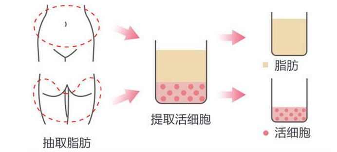 福州自体脂肪面部填充价格费用多少？解析！