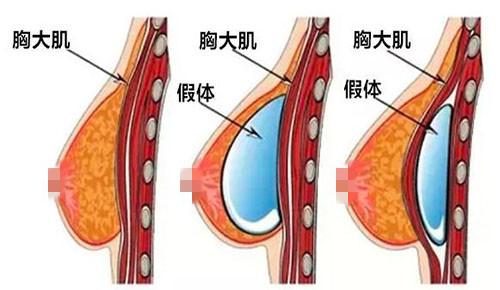 广州自体脂肪丰胸医院哪家好？价格费用多少？
