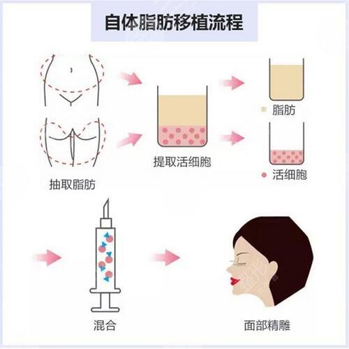 大连自体脂肪丰胸价格费用多少？解析影响因素