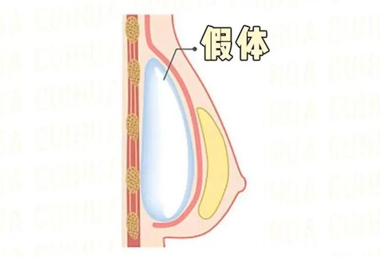 河北注射隆胸效果怎么样，价格费用多少？