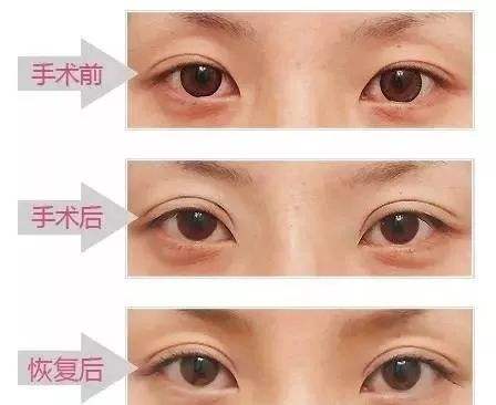 上海九院眼部整形价格表（价目表）_九院双眼皮专家门诊时间