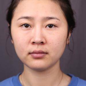 上海华美杨亚益个人简介_杨亚益双眼皮+开眼角案例_杨亚益双眼皮价格