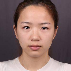 上海华美杨亚益个人简介_杨亚益双眼皮+开眼角案例_杨亚益双眼皮价格