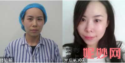 郑州华领医疗美容徐刚强医生技术如何?擅长项目,自体脂肪填充案例,价格