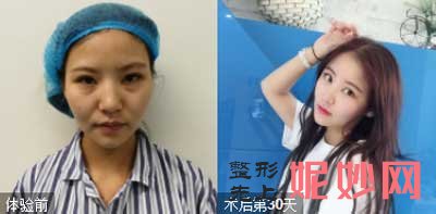 郑州华领医疗美容徐刚强医生技术如何?擅长项目,自体脂肪填充案例,价格