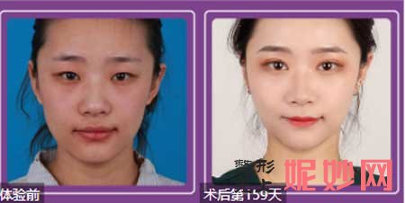 北京协和整形医院王晓军技术怎么样?擅长项目,坐诊时间,真人案例