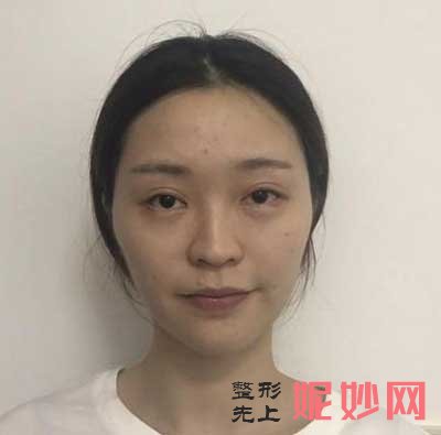 北京联合丽格师俊莉做鼻子技术好吗?会失败吗?费用是多少啊?