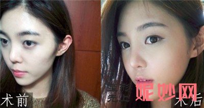 上海华美医疗美容田波医生技术怎么样？颧骨+自体软骨隆鼻案例,介绍,价格