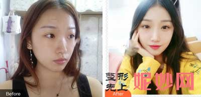 湘雅三医院韩朝飞医生做疤痕修复效果怎么样?疤痕修复案例,价格,门诊时间表