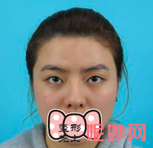 卢元刚做鼻子怎么样？
