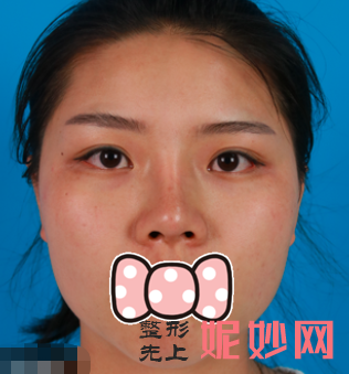 李敏医生做鼻子怎么样？