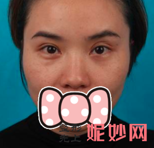 赵兰明医生做鼻子怎么样？