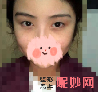 沈燕华做双眼皮修复怎么样？