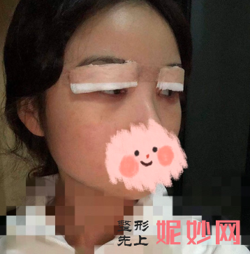 沈燕华做双眼皮修复怎么样？