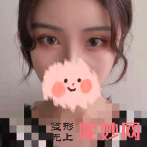 沈燕华做双眼皮修复怎么样？