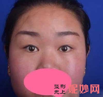 颜子云做双眼皮怎么样？
