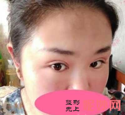 颜子云做双眼皮怎么样？