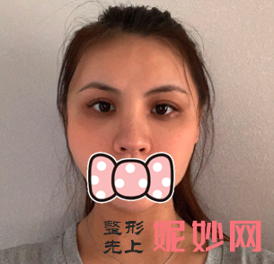 颜子云做鼻子怎么样？