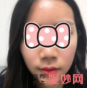 黄富伟做鼻子怎么样？