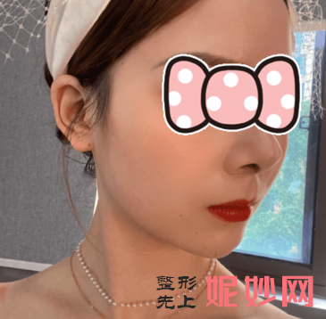 成都市西区医院隆鼻怎么样？