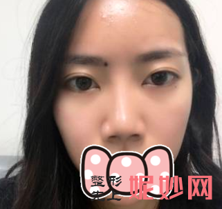 毛健清鼻子做的怎么样？