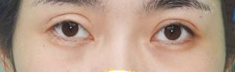 谭章梅修复双眼皮究竟怎么样?案例分享加价格表
