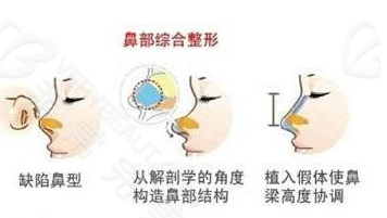 杨水斌医生做鼻子要多少钱呢?内附价格表