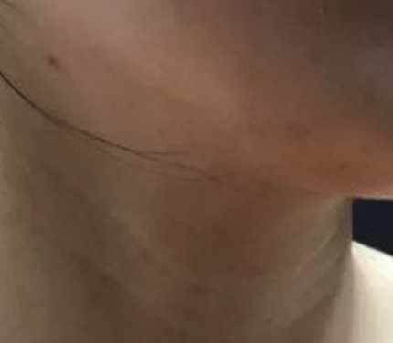 华美许恺燕医生的嗨体注射值得推荐吗?内附真实案例分享