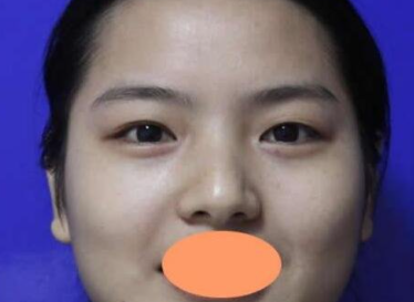 南京美来莱曹经栋做双眼皮怎么样?内附案例分享价格表