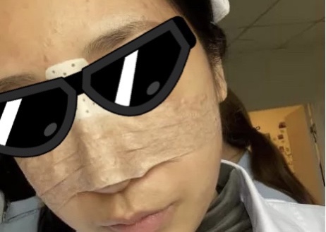 南京艺星朱刚强鼻子做得怎么样?内附案例分享价格表