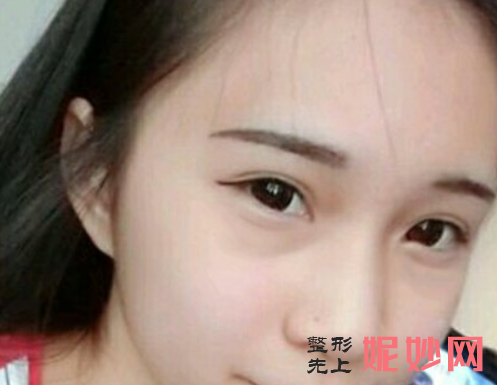 范志宏医生祛眼袋怎么样？效果好吗？附医生介绍+案例分享~