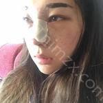 上海鹏爱医疗美容门诊部李涛技术怎么样?内附案例效果较新价格表