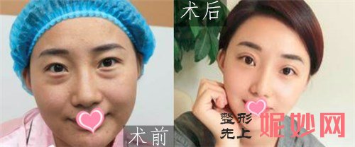 北京画美医院的马群医生怎么样？全切双眼皮案例,价格,介绍