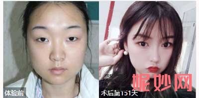 北京师俊莉医生做鼻子技术怎么样?分析,案例,价格