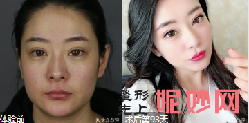 北京刘风卓和王世勇哪个医生做双眼皮修复好?