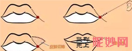 “M唇”手术内切的效果怎么样？术后的注意事项有哪些？