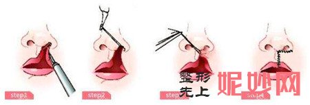 杭州华山连天美的李文鹏医生做唇腭裂修复怎么样？安全吗？