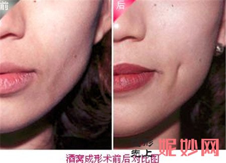 什么是酒窝成形术？上海清杨整形医院做酒窝成形术多少钱？