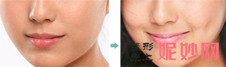 什么是酒窝成形术？上海清杨整形医院做酒窝成形术多少钱？