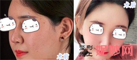 丁庆丰做的鼻子怎么样？