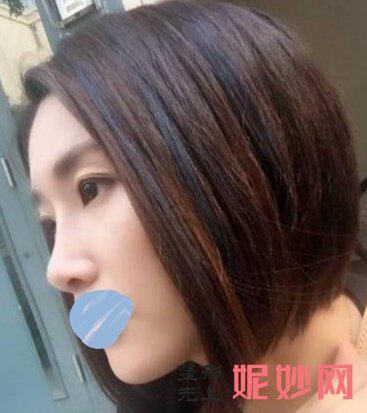 四川省人民整形外科刘全隆鼻，帮你摆脱塌鼻子！