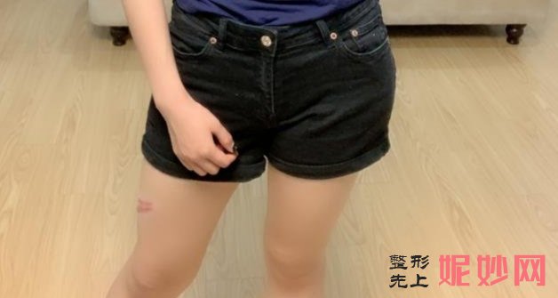 四川人民医院整形科张家建做疤痕去除，不会留下一点痕迹！